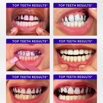 Purple Whitening Strips™