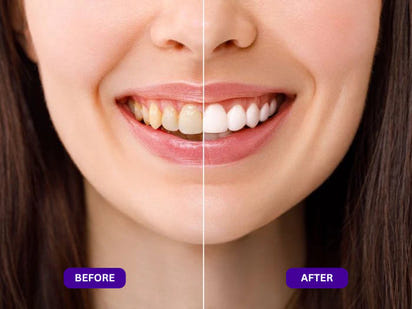 Purple Whitening Strips™