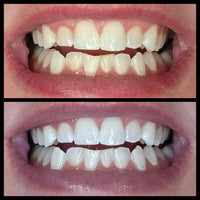 Purple Whitening Strips™
