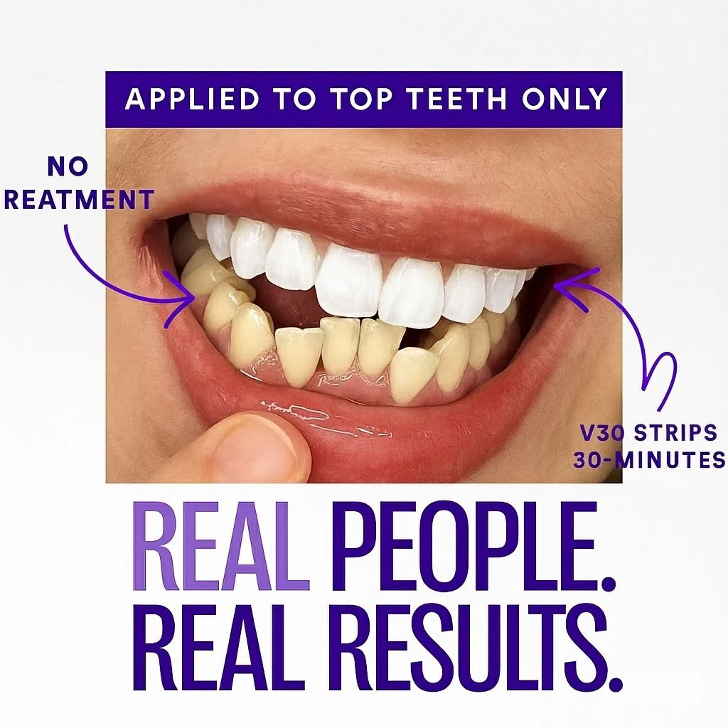 Purple Whitening Strips™
